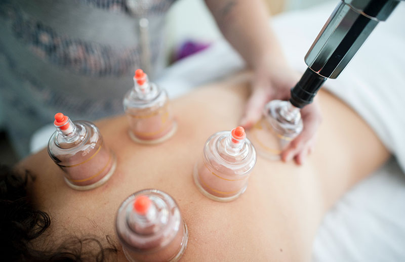 blog image - fire cupping on back