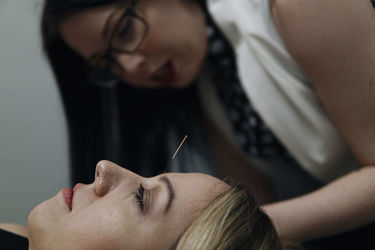 Acupuncture treatment in progress at the Movement Performance Health Clinic.